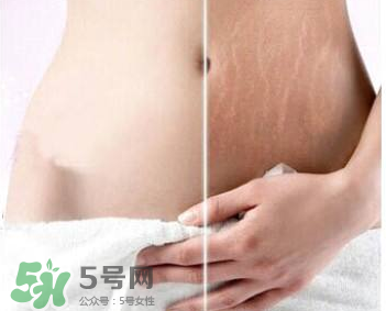妊娠紋怎么長(zhǎng)在大腿上了？妊娠紋會(huì)不會(huì)長(zhǎng)在大腿上？