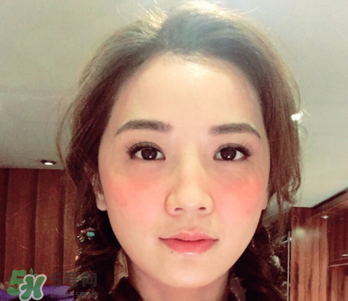 夏天可以點(diǎn)痣嗎？夏天點(diǎn)痣后要注意什么？