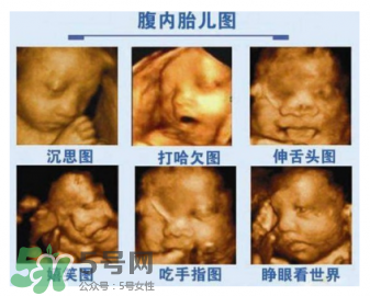 四維彩超有必要做嗎？四維彩超檢查不出什么？