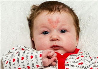 寶寶胎記是怎么來的？寶寶胎記是怎么形成的？