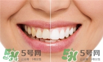 冷光美牙是什么?冷光美牙的特點(diǎn) 冷光美牙是什么?冷光美牙的特點(diǎn)