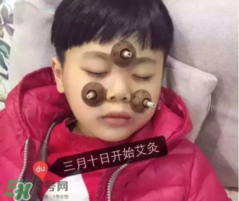 艾灸貼可以治咳嗽嗎？艾灸貼可以治退燒嗎？