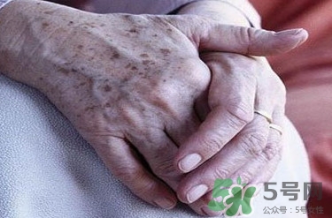 老年斑多大年齡開始有？為什么牙膏能去老年斑？