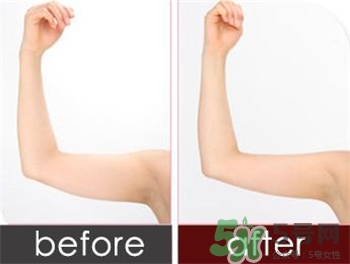 水動(dòng)力吸脂的優(yōu)點(diǎn) 水動(dòng)力吸脂的缺點(diǎn) 水動(dòng)力吸脂的優(yōu)點(diǎn) 水動(dòng)力吸脂的缺點(diǎn)