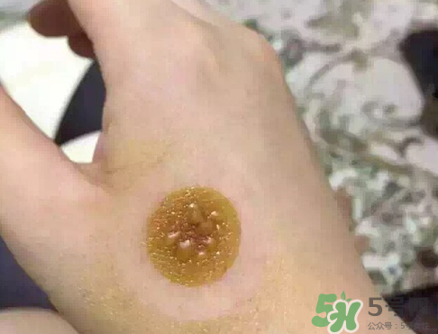 艾灸貼后有水泡怎么辦？貼艾灸貼應(yīng)注意些什么？