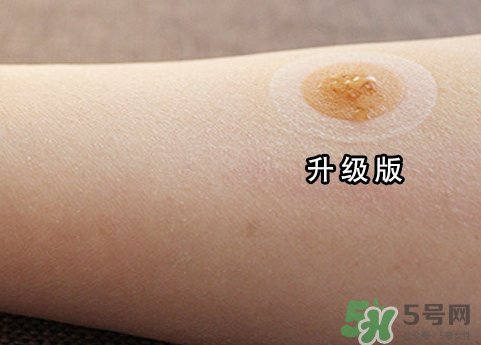 艾灸貼后有水泡怎么辦？貼艾灸貼應(yīng)注意些什么？