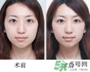 填充淚溝有風險嗎？填充淚溝的方法