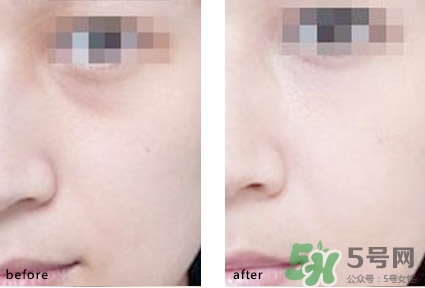 淚溝能自己恢復(fù)嗎？淚溝怎么自己恢復(fù)？