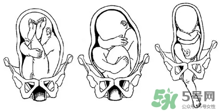 胎位不正能順產(chǎn)嗎？胎位不正怎么辦？