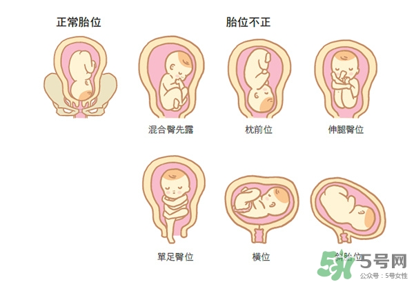 胎位不正如何矯正？胎位不正一定要剖腹產(chǎn)嗎？