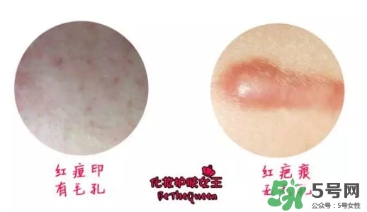 祛紅色痘印用什么藥膏 各色痘印祛除方法 祛紅色痘印用什么藥膏 各色痘印祛除方法