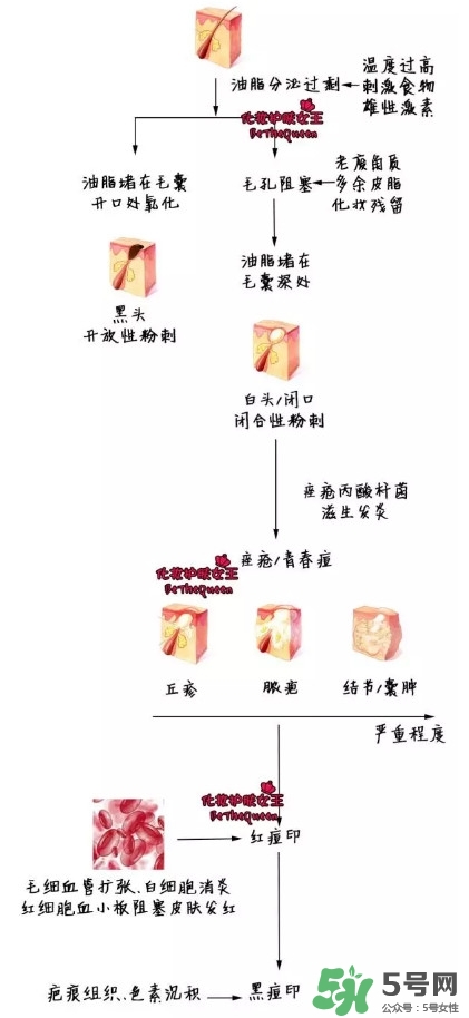 祛紅色痘印用什么藥膏 各色痘印祛除方法 祛紅色痘印用什么藥膏 各色痘印祛除方法