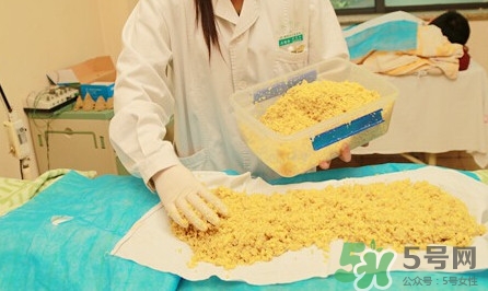 隔姜灸效果怎么樣？隔姜灸好還是直接灸好