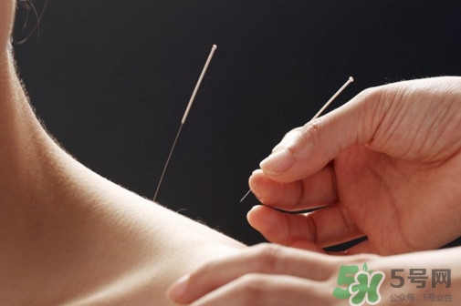 針灸可以天天扎嗎？針灸可以每天扎嗎