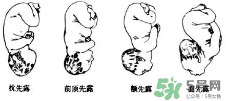 胎位不正能順產(chǎn)嗎？胎位不正怎么辦？