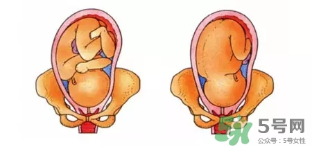 胎位不正能順產(chǎn)嗎？胎位不正怎么辦？