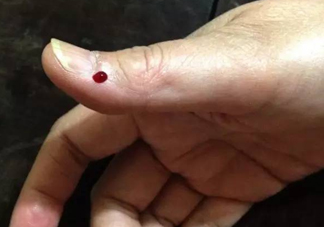 什么人不能做放血療法？放血療法有什么功效？