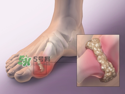 艾艾貼能治痛風(fēng)嗎？艾艾貼治風(fēng)濕嗎？