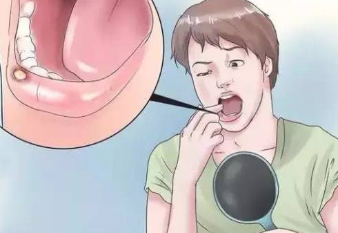 口腔潰瘍牙齦腫痛怎么辦？口腔潰瘍是什么樣子