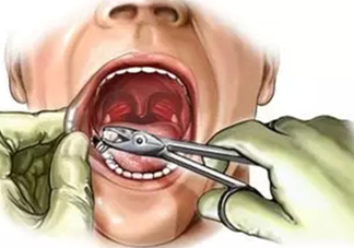 三伏天可以拔牙嗎嗎?三伏天拔牙好嗎？