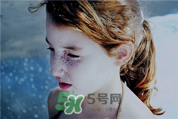 曬斑和雀斑是一樣的嗎?曬斑和雀斑的區(qū)別 曬斑和雀斑是一樣的嗎?曬斑和雀斑的區(qū)別