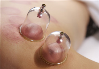 拔火罐后顏色多久消失？拔火罐印子多久能消除？