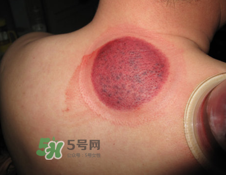 三伏天拔罐后多久可以洗澡？三伏天拔罐后注意事項