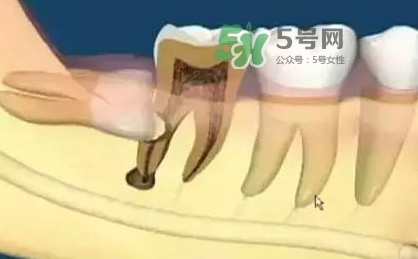 智齒是每個人都會長嗎？拔智齒能瘦臉嗎？