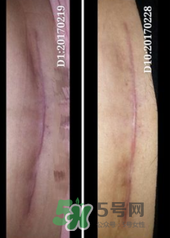 Biodermis百德絲疤痕貼有效嗎？Biodermis百德絲疤痕貼好用嗎？