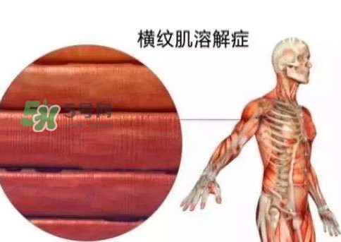 橫紋肌溶解癥會死亡嗎？橫紋肌溶解癥能活多久