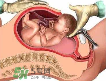 剖腹產(chǎn)比順產(chǎn)安全嗎？剖腹產(chǎn)產(chǎn)后注意事項(xiàng)？