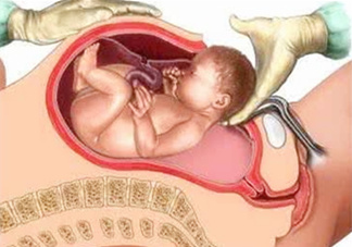 剖腹產(chǎn)比順產(chǎn)安全嗎？剖腹產(chǎn)產(chǎn)后注意事項？