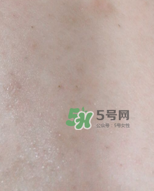 Dermatix舒痕疤痕膏有效嗎？Dermatix舒痕疤痕膏怎么用？