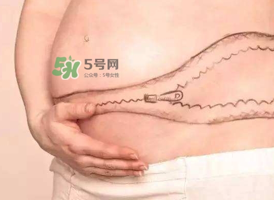 剖腹產疤痕怎么去除？剖腹產疤痕能去掉嗎？