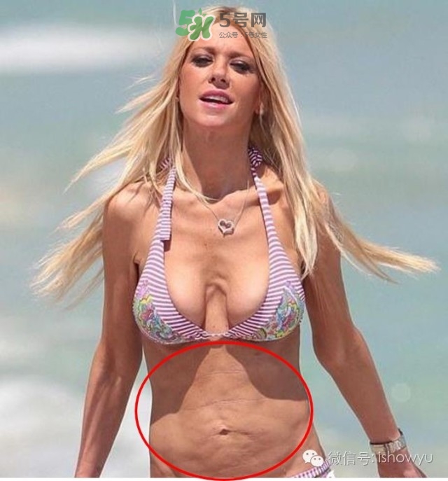 酷塑溶脂效果對比圖片 酷塑溶脂全過程記錄 酷塑溶脂效果對比圖片 酷塑溶脂全過程記錄