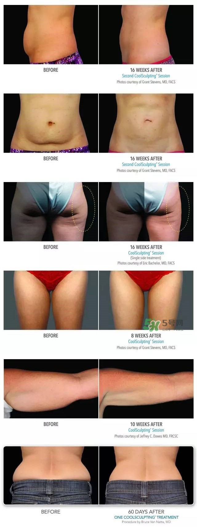 酷塑溶脂效果對比圖片 酷塑溶脂全過程記錄 酷塑溶脂效果對比圖片 酷塑溶脂全過程記錄