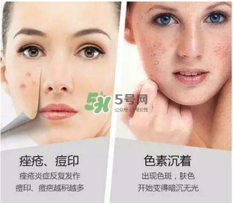 果酸換膚自己可以做嗎？果酸換膚后注意事項