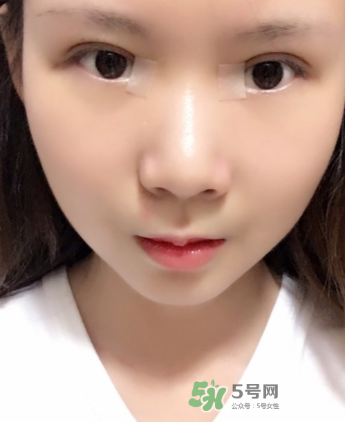 美皮護(hù)去疤效果怎么樣？美皮護(hù)有用嗎？