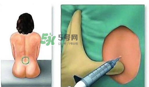 無痛分娩為什么不提倡？無痛分娩有后遺癥嗎？