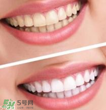 碧緹福美牙儀對(duì)牙齒有傷害嗎？碧緹福美牙儀會(huì)反彈嗎？