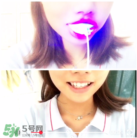 美牙儀能治氟斑牙嗎？氟斑牙可以用美白儀嗎？