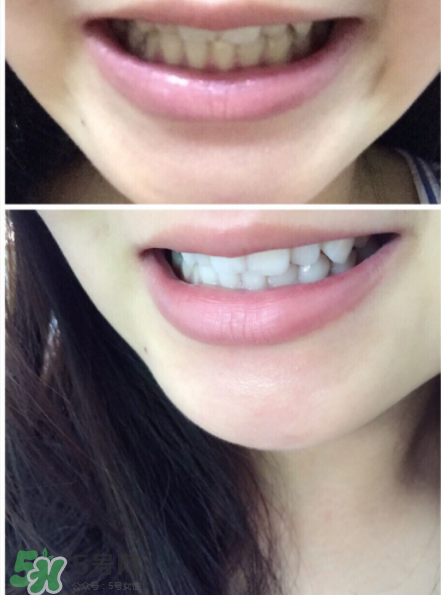 美牙儀能用水洗嗎？美牙儀能用多久？