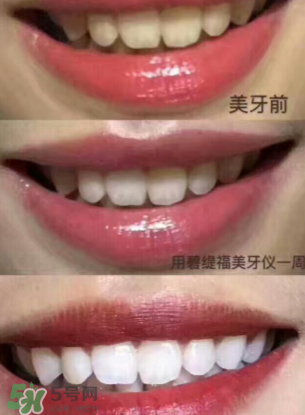 美牙儀能用水洗嗎？美牙儀能用多久？