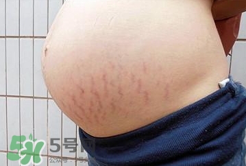 妊娠紋什么時(shí)候開始預(yù)防？妊娠紋什么時(shí)候消除？