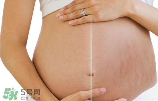 妊娠紋在左邊生男或女？怎么從妊娠紋看男女？