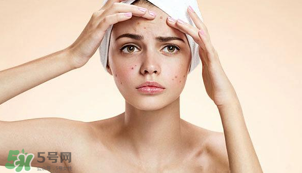 長痘長閉口怎么辦？長痘長閉口是什么原因？