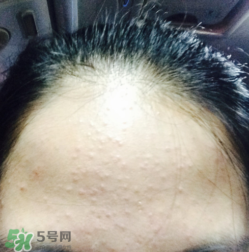 長痘長閉口怎么辦？長痘長閉口是什么原因？