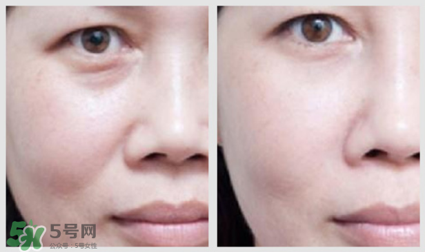 法令紋怎么消除？如何正確對待法令紋？