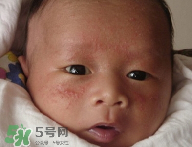 新生兒痤瘡怎么治療-癥狀 新生兒痤瘡怎么治療-癥狀
