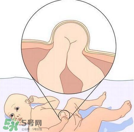 臍疝是什么？臍疝對寶寶有什么影響？